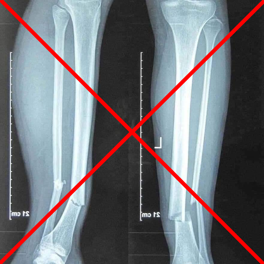 Bức ảnh chụp X-quang chân của Hùng Dũng là sai sự thật.