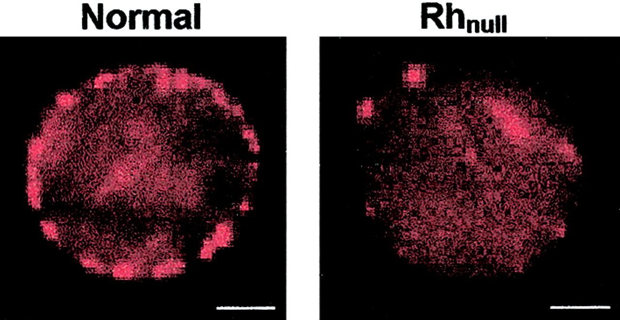 Hình ảnh so sánh giữa một tế bào hồng cầu bình thường và một tế bào hồng cầu của người nhóm máu Rh-null.