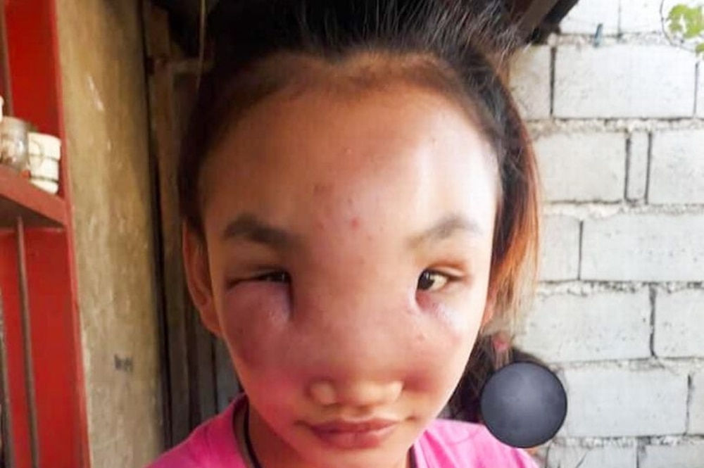 Gương mặt của cô gái bị sưng phồng sau khi nặn mụn trên mũi.