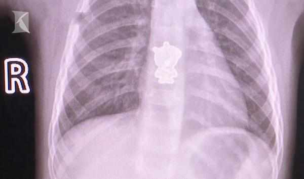 Bé gái ho ra máu vì nuốt phải hình dán heo Peppa