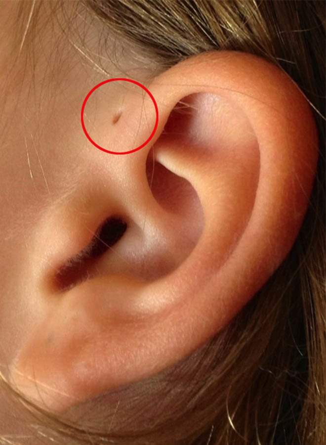 Bệnh rò lỗ luân nhĩ sẽ có một lỗ nhỏ trên vành tai.