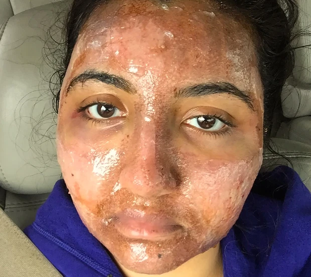 Cô nàng từng bị tai nạn xe hơi khiến gương mặt mình bị bỏng nặng đến mức biến dạng.