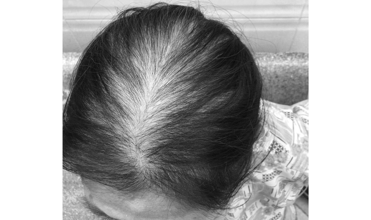 Rụng tóc là bệnh lý gặp nhiều thứ 4 ở bệnh nhân mắc Covid-19