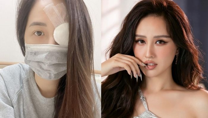 Fan lo lắng khi Mai Phương Thúy nhập viện với 1 bên mắt băng kín, hối hận vì tự chữa bệnh tại nhà