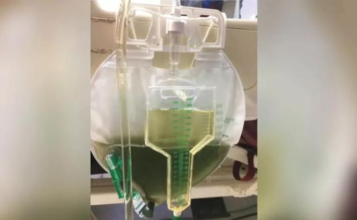 Kỳ lạ nước tiểu của bệnh nhân 62 tuổi chuyển màu xanh lá sau 5 ngày nằm viện - Ảnh 1
