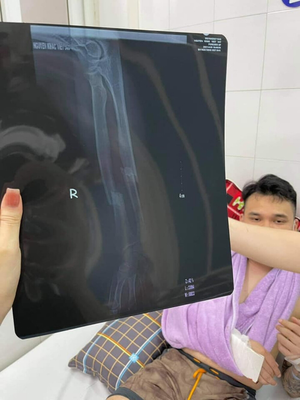 Hình chụp X - Quang cho thấy phần xương cẳng tay của nam ca sĩ đã bị gãy đôi.