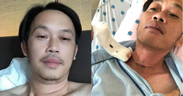 Dân mạng soi ra điểm bất thường vào ngày Hoài Linh phẫu thuật K tuyến giáp