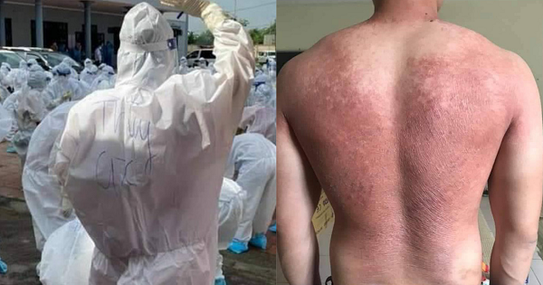 Xót xa hình ảnh tấm lưng cháy nắng phồng rộp của bác sĩ tại tâm dịch Bắc Giang