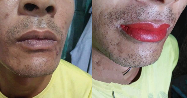 Ông bố nghe lời hàng xóm đi khử môi thâm và kết quả