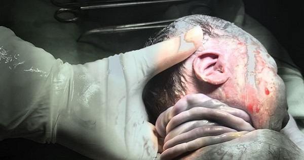 Hy hữu: Bé trai ở Hà Nội chào đời an toàn với 7 vòng dây rốn quấn chặt cổ