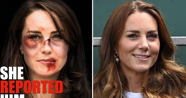  Hình ảnh Công nương Kate với gương mặt thâm đen như bị đánh gây phẫn nộ