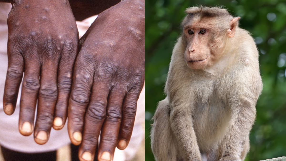 WHO xác nhận 92 ca bệnh đậu mùa khỉ trên thế giới, khả năng bùng phát cao