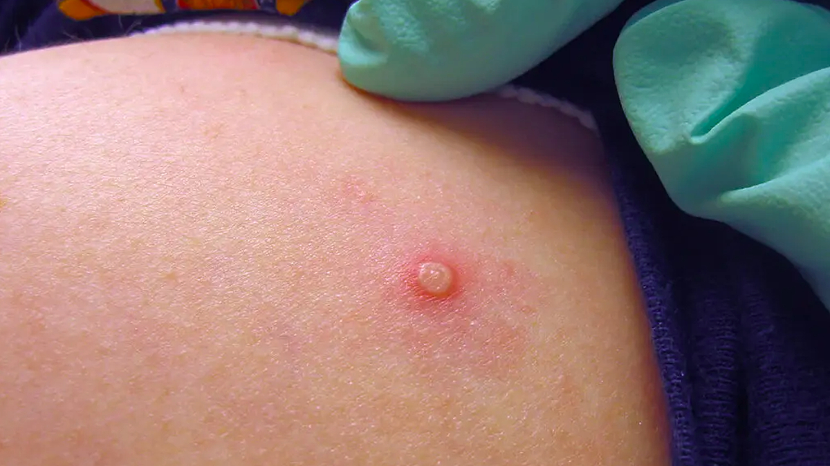 WHO tuyên bố đậu mùa khỉ là tình trạng khẩn cấp y tế toàn cầu