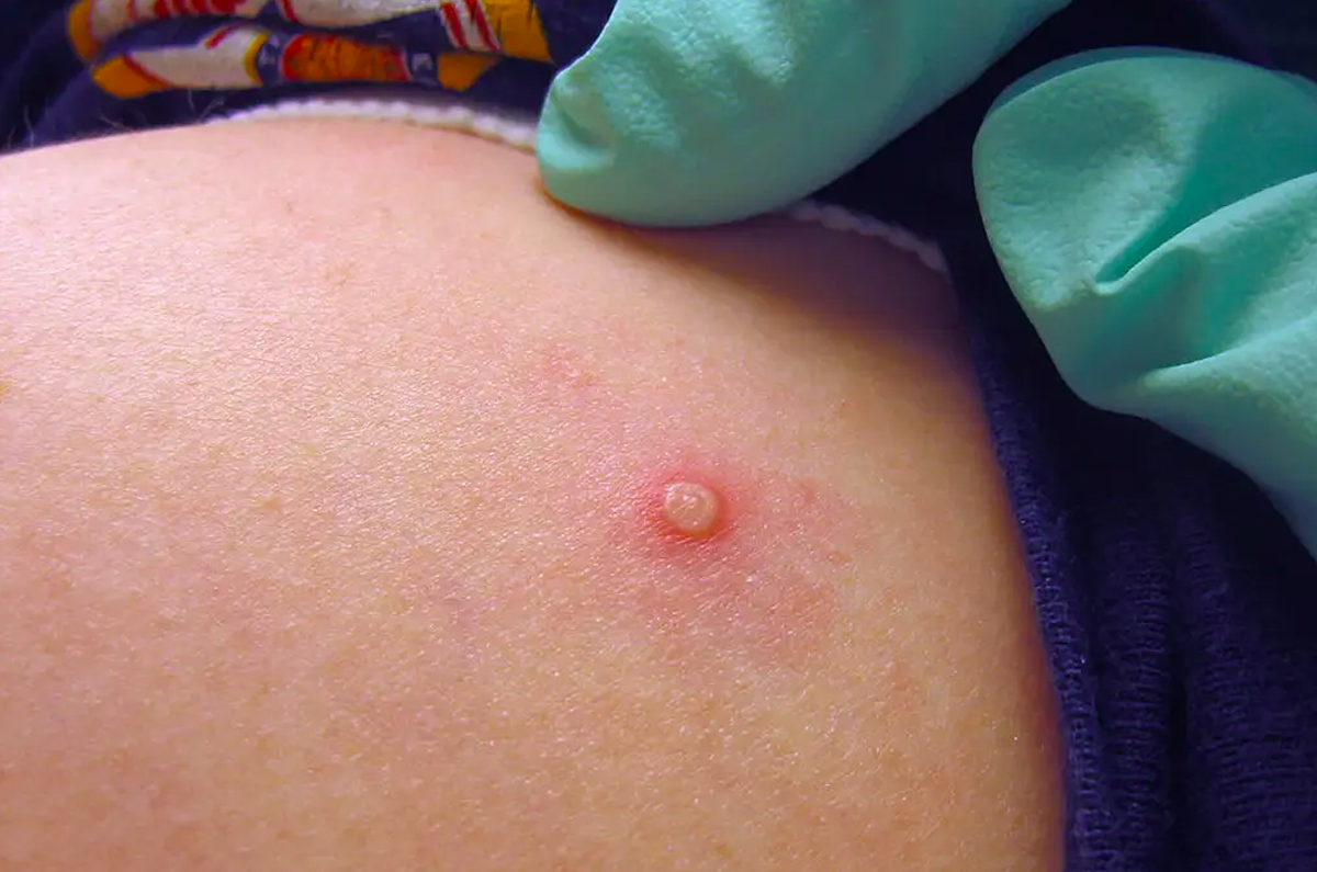 WHO tuyên bố đậu mùa khỉ là tình trạng khẩn cấp y tế toàn cầu - Ảnh 1