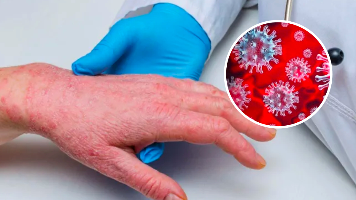 Châu Âu ghi nhận ca tử vong đậu mùa khỉ đầu tiên ở Tây Ban Nha