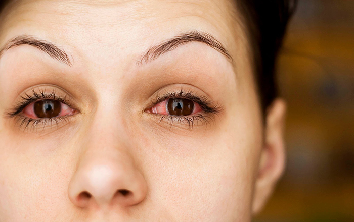 Bệnh đau mắt đỏ do virus gây ra không cần điều trị bằng thuốc.