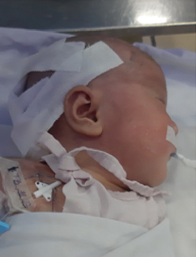 Bé trai sơ sinh đã được các bác sĩ Bệnh viện Nhi đồng 1 (TP.HCM) phẫu thuật loại bỏ khối u thành công.