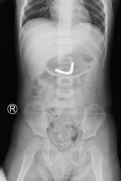 Hình ảnh chụp x-quang dị vật ở trong bụng của bệnh nhi.