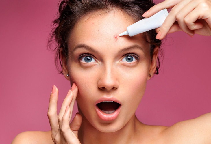 Xướng tên 4 loại kem trị mụn hữu hiệu được ưa chuộng