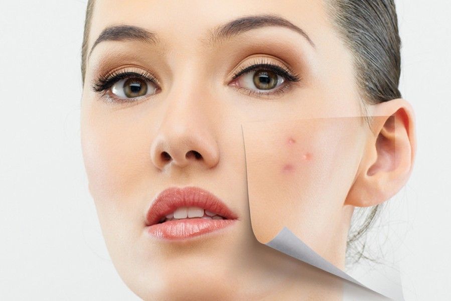 Xướng tên 4 loại kem trị thâm mụn hữu hiệu cho mọi loại da