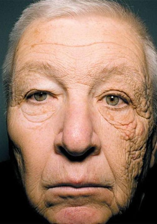 Hình ảnh một bên mặt của người đàn ông bị chảy xệ do thường xuyên tiếp xúc với ánh nắng mặt trời.